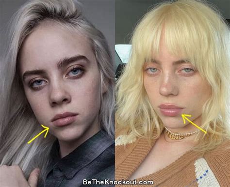 billie eilish plastic surgery